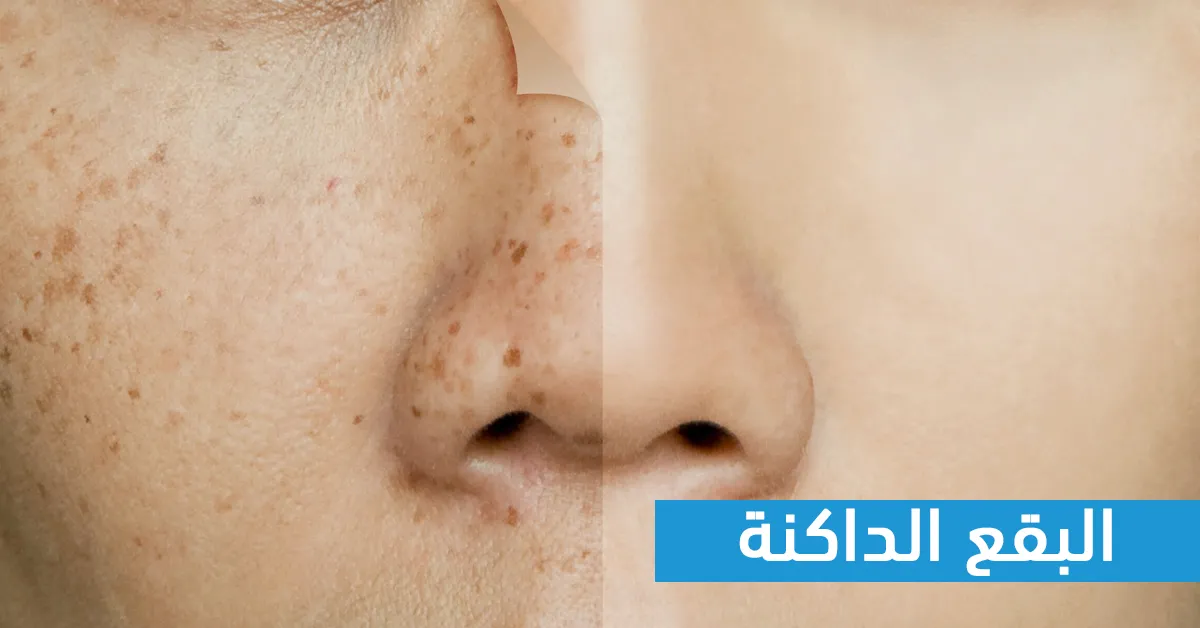 البقع الدكنة